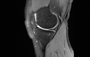 Uszkodzenie rogu tylnego łąkotki przyśrodkowej kolana w obrazie MR